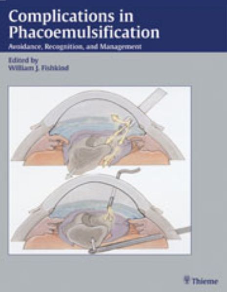 William J. Fishkind Fishkind Complications in Phacoemulsification
