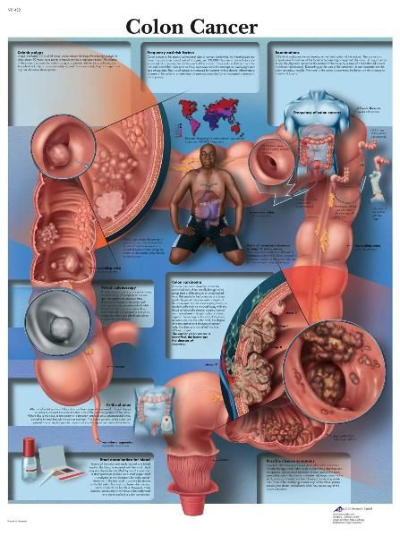   Colon Cancer