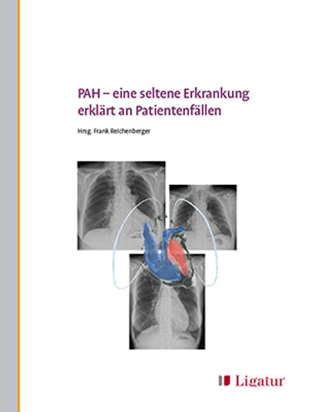  Frank PAH – eine seltene Erkrankung erklärt an Patientenfällen